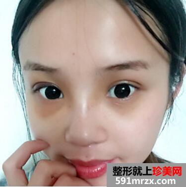 硅胶假体隆鼻好吗 看看我的变化就知道了