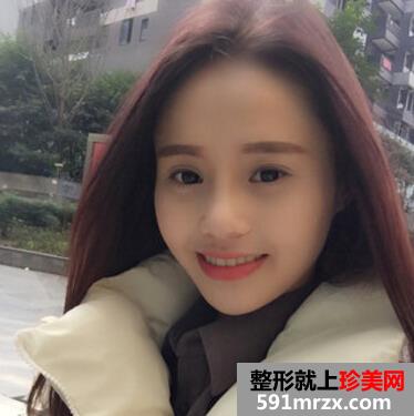 硅胶假体隆鼻好吗 看看我的变化就知道了