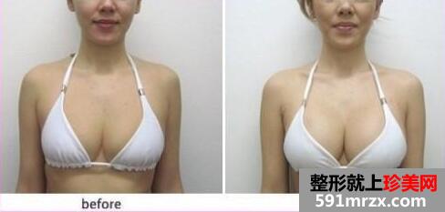 隆胸整形手术过程图介绍 让我自信起来