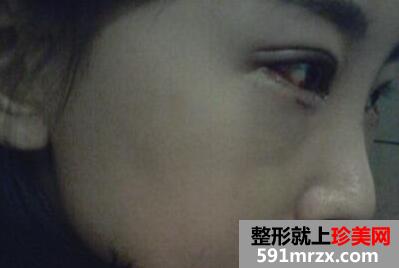 开内外眼角真人案例最新版倾情分享