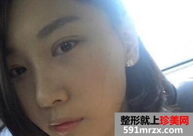 开内外眼角真人案例最新版倾情分享