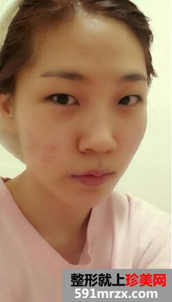 埋线法双眼皮硅胶隆鼻自体脂肪填充手术的真人案例分享