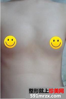 水滴形假体隆胸手术+切除法去副乳最新真实案例