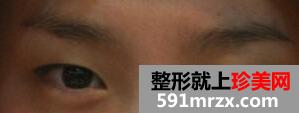 埋线法双眼皮+硅胶隆鼻手术前后对比图