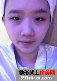 韩式双眼皮+韩式隆鼻丑小鸭秒变小公主案例前后对比图