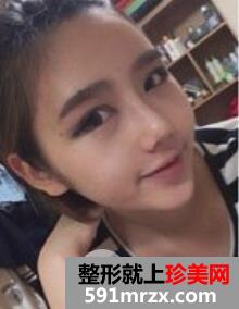 韩式双眼皮+韩式隆鼻丑小鸭秒变小公主案例前后对比图
