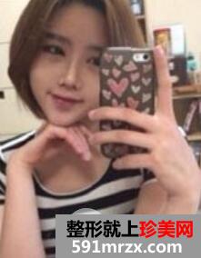 韩式双眼皮+韩式隆鼻丑小鸭秒变小公主案例前后对比图