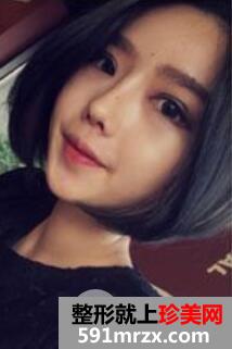 韩式双眼皮+韩式隆鼻丑小鸭秒变小公主案例前后对比图