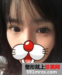 埋线双眼皮+内眦手术+玻尿酸隆鼻案例分享前后对比图