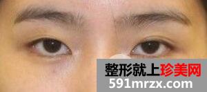 埋线双眼皮+内眦手术+玻尿酸隆鼻案例分享前后对比图