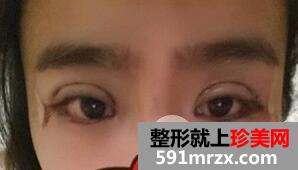 埋线双眼皮+内眦手术+玻尿酸隆鼻案例分享前后对比图