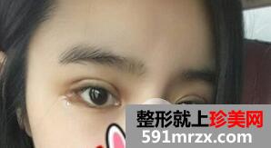埋线双眼皮+内眦手术+玻尿酸隆鼻案例分享前后对比图