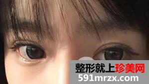 埋线双眼皮+内眦手术+玻尿酸隆鼻案例分享前后对比图