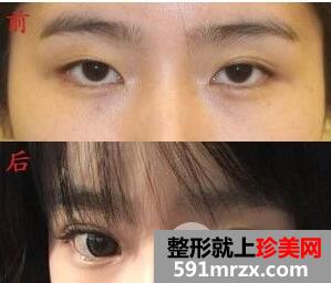 埋线双眼皮+内眦手术+玻尿酸隆鼻案例分享前后对比图