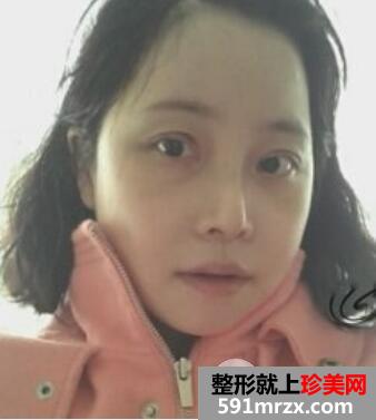 韩式双眼皮+假体隆鼻+面部轮廓手术真实案例恢复全过程