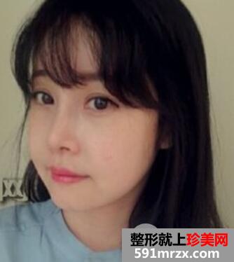 韩式双眼皮+假体隆鼻+面部轮廓手术真实案例恢复全过程