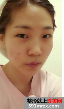 记录全切双眼皮开眼角+假体隆鼻手术恢复全过程对比照