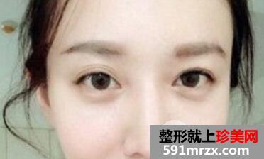 双眼皮失败案例埋线双眼皮修复+开眼角重现大眼