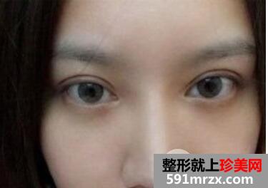 双眼皮失败案例埋线双眼皮修复+开眼角重现大眼