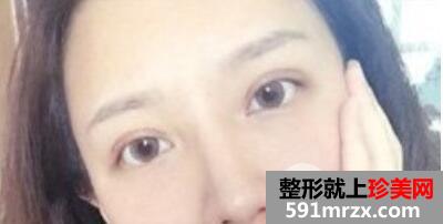 双眼皮失败案例埋线双眼皮修复+开眼角重现大眼