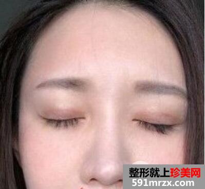 双眼皮失败案例埋线双眼皮修复+开眼角重现大眼