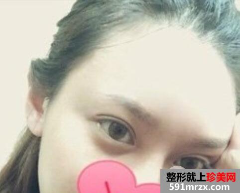 双眼皮失败案例埋线双眼皮修复+开眼角重现大眼