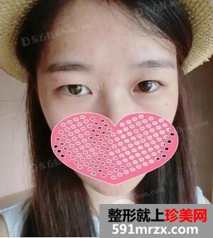 全切双眼皮8mm宽的大平行真人案例恢复图片