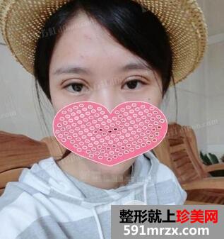 全切双眼皮8mm宽的大平行真人案例恢复图片