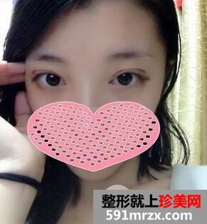 全切双眼皮8mm宽的大平行真人案例恢复图片