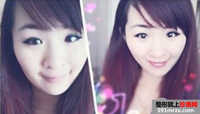肿泡眼割双眼皮的真实整形案例分享有图有真相