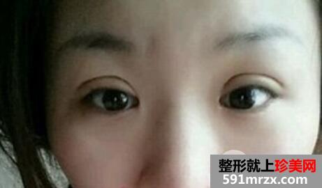 肿泡眼割双眼皮的真实整形案例分享有图有真相