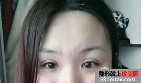 肿泡眼割双眼皮的真实整形案例分享有图有真相