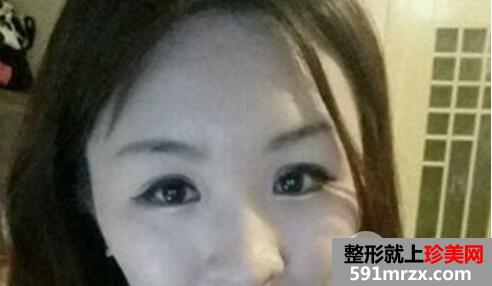 肿泡眼割双眼皮的真实整形案例分享有图有真相