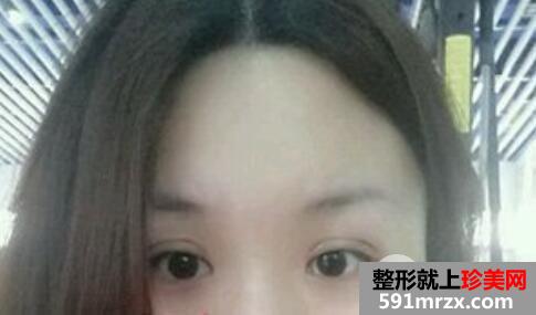 肿泡眼割双眼皮的真实整形案例分享有图有真相