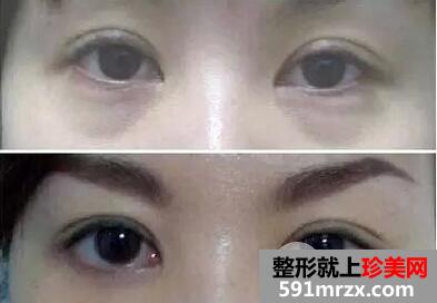 激光去眼袋整形手术要多少钱激光去眼袋疼吗