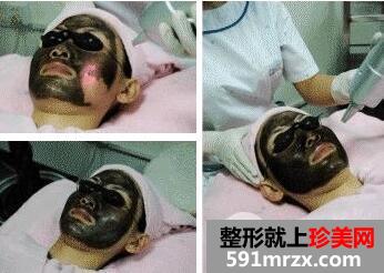 黑脸娃娃的原理你知道吗 黑脸娃娃美容一般多少钱