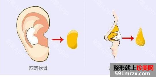 自体耳软骨隆鼻手术的价格 耳软骨隆鼻的效果怎么样