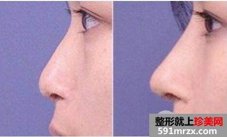 自体耳软骨隆鼻手术的价格 耳软骨隆鼻的效果怎么样