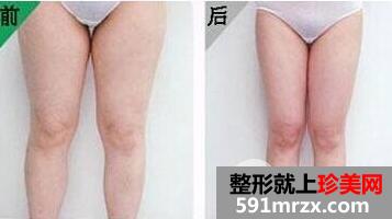 大腿吸脂手术要多少钱 大腿吸脂整形的注意事项有哪些