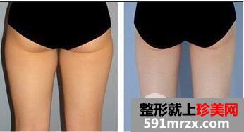 大腿吸脂手术要多少钱 大腿吸脂整形的注意事项有哪些