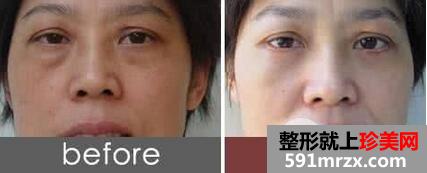 外切眼袋多久恢复图片 外切眼袋手术需要多少钱