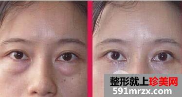 外切眼袋多久恢复图片 外切眼袋手术需要多少钱