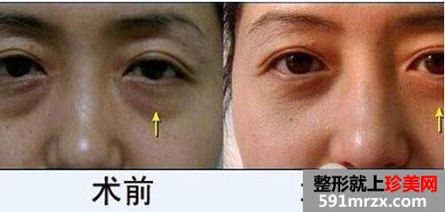 外切眼袋多久恢复图片 外切眼袋手术需要多少钱