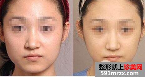 瘦脸针多钱一针 打瘦脸针的注意事项有哪些
