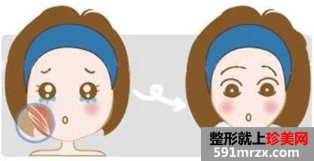 脸吸脂一般多少钱 面部吸脂整形手术的注意事项