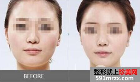 脸吸脂一般多少钱 面部吸脂整形手术的注意事项
