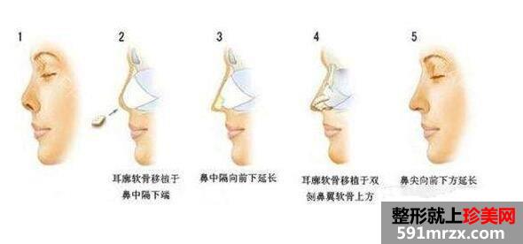 自体耳软骨隆鼻价格 自体软骨隆鼻整形手术效果如何