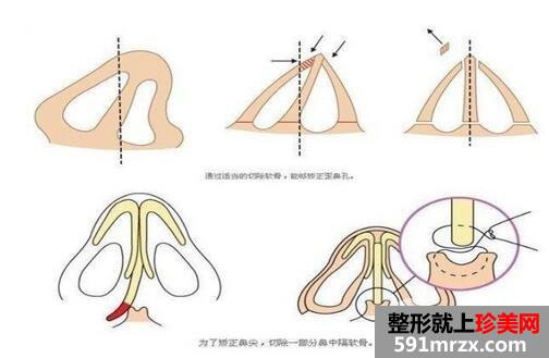 自体耳软骨隆鼻价格 自体软骨隆鼻整形手术效果如何