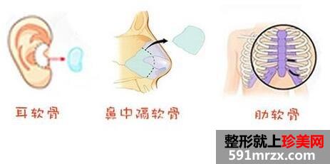 自体耳软骨隆鼻价格 自体软骨隆鼻整形手术效果如何