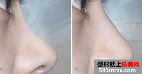 自体耳软骨隆鼻价格 自体软骨隆鼻整形手术效果如何